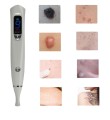laser-pen-plazma-kosmetyczna-mole-pen-v2-usuwanie-tatuazu-blizn-brodawek-4.jpeg