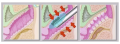 3D-HIFU-glowica-gynekologiczna9620.png